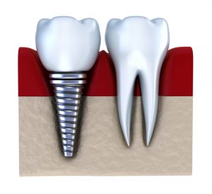 Dental Implant Dentist Tysons Corner VA