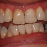 invisalign and veneers