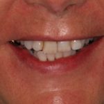 invisalign and veneers