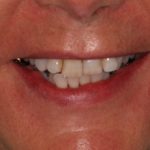 invisalign and veneers