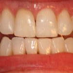 invisalign and veneers