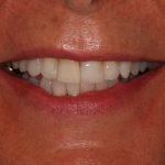 invisalign and veneers