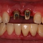 dental implant