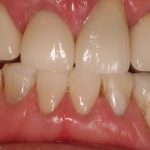 After bonding and anterior crowns
