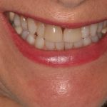 Veneers before Invisalign