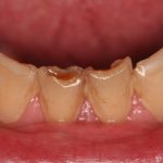 Chipped anterior teeth