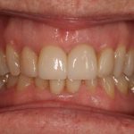 After invisalign