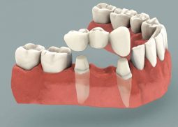 dental bridge