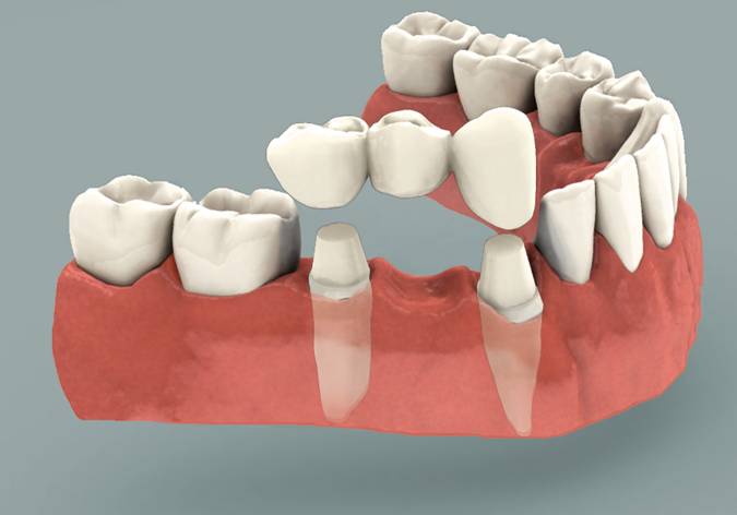 dental bridge