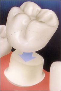 dental crown