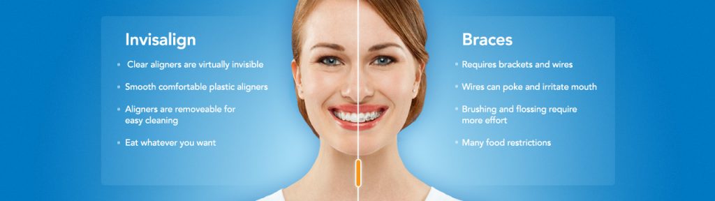 invisalign tysons corner va