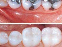 tooth colored fillings