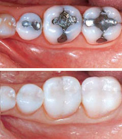 tooth colored fillings