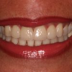 after veneers