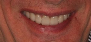 After Postrestorative Front Intraoral