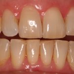 teeth after dental procedure