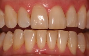 teeth after dental procedure