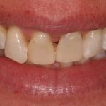 teeth before dental procedure