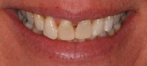 teeth before dental procedure