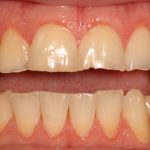 Postrestorative Front Intraoral