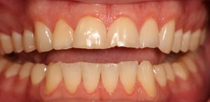 Postrestorative Front Intraoral