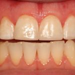 Postrestorative Front Intraoral