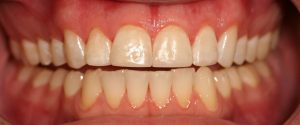 Postrestorative Front Intraoral