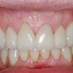 Postrestorative Front Intraoral