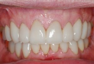 Postrestorative Front Intraoral